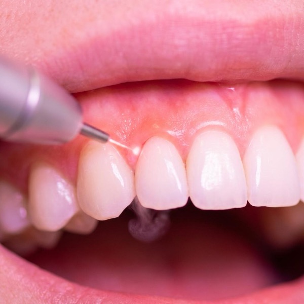 Sub Gum Contouring